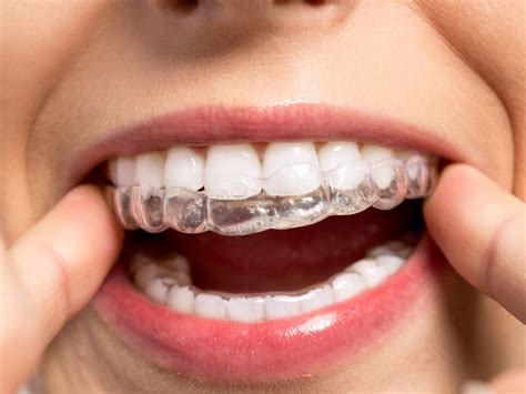 invisalign metal brackets|how are invisalign attachments removed.